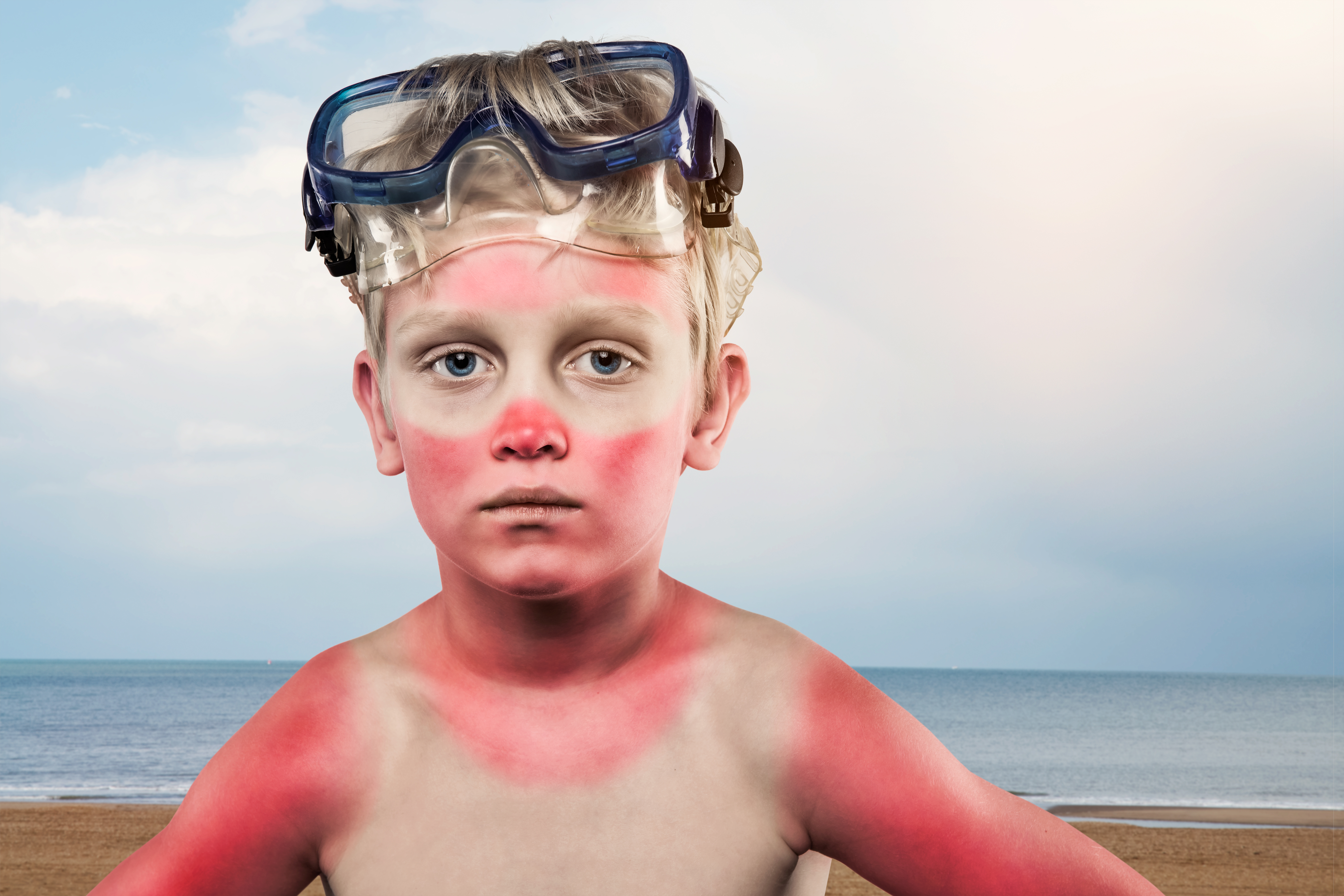 Sunburned boy